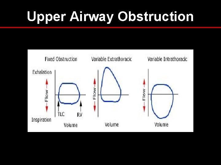 Upper Airway Obstruction Upper Airway Obstruction