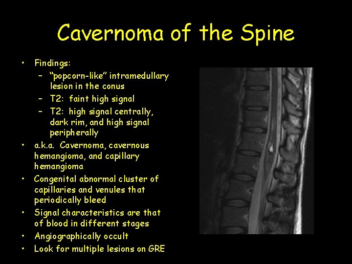Cavernoma of the Spine • • • Findings: – “popcorn-like” intramedullary lesion in the