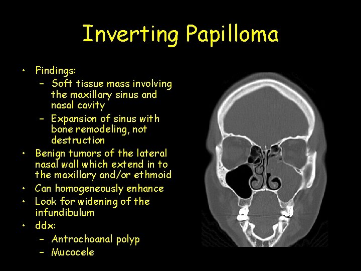 Inverting Papilloma • Findings: – Soft tissue mass involving the maxillary sinus and nasal