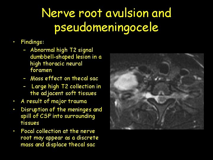Nerve root avulsion and pseudomeningocele • Findings: – Abnormal high T 2 signal dumbbell-shaped