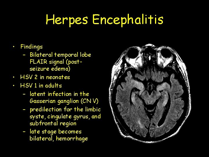 Herpes Encephalitis • Findings – Bilateral temporal lobe FLAIR signal (postseizure edema) • HSV