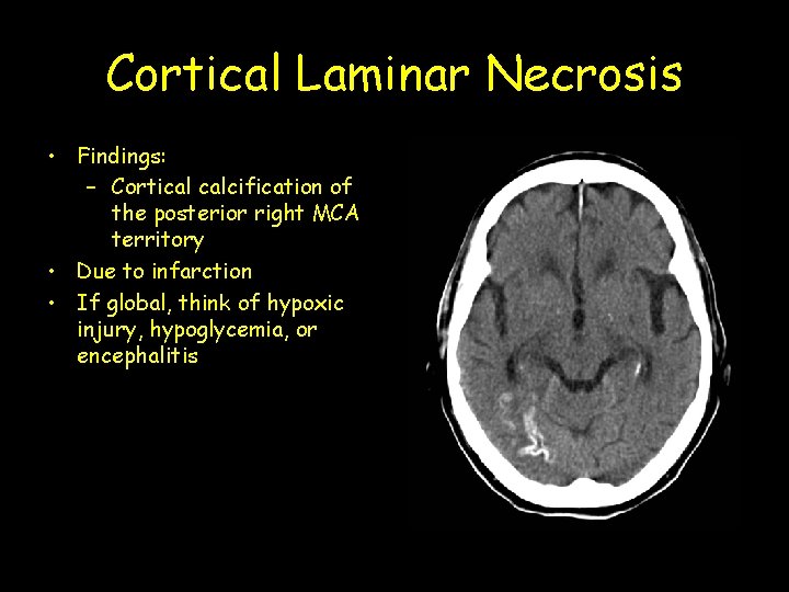 Cortical Laminar Necrosis • Findings: – Cortical calcification of the posterior right MCA territory