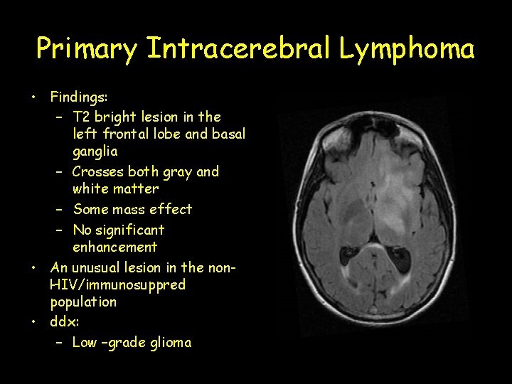 Primary Intracerebral Lymphoma • Findings: – T 2 bright lesion in the left frontal
