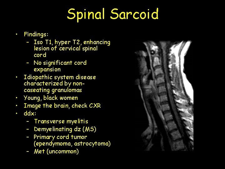 Spinal Sarcoid • Findings: – Iso T 1, hyper T 2, enhancing lesion of