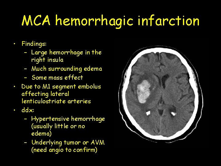 MCA hemorrhagic infarction • Findings: – Large hemorrhage in the right insula – Much