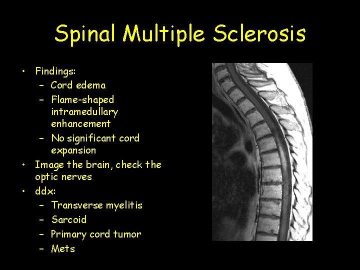 Spinal Multiple Sclerosis • Findings: – Cord edema – Flame-shaped intramedullary enhancement – No
