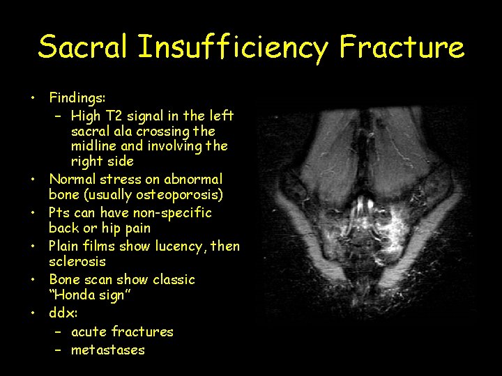 Sacral Insufficiency Fracture • Findings: – High T 2 signal in the left sacral