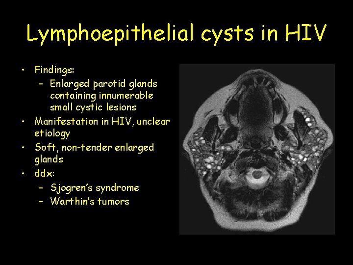 Lymphoepithelial cysts in HIV • Findings: – Enlarged parotid glands containing innumerable small cystic
