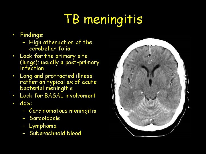 TB meningitis • Findings: – High attenuation of the cerebellar folia • Look for
