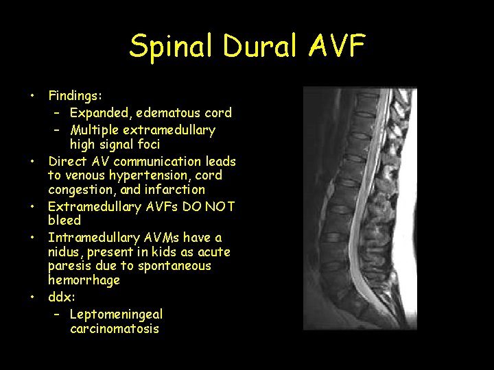 Spinal Dural AVF • Findings: – Expanded, edematous cord – Multiple extramedullary high signal