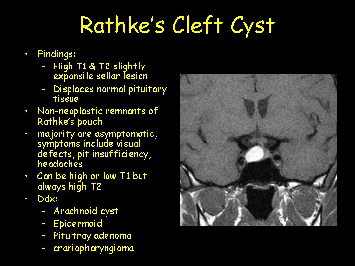 Rathke’s Cleft Cyst • Findings: – High T 1 & T 2 slightly expansile
