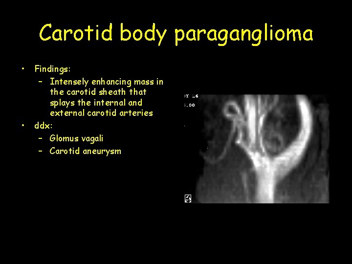 Carotid body paraganglioma • • Findings: – Intensely enhancing mass in the carotid sheath