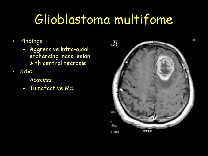Glioblastoma multifome • Findings: – Aggressive intra-axial enchancing mass lesion with central necrosis •