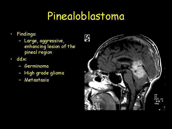 Pinealoblastoma • Findings: – Large, aggressive, enhancing lesion of the pineal region • ddx: