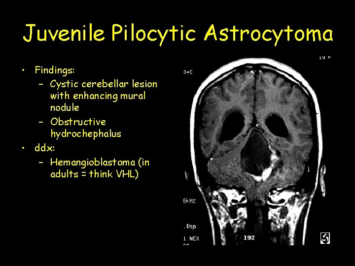 Juvenile Pilocytic Astrocytoma • Findings: – Cystic cerebellar lesion with enhancing mural nodule –