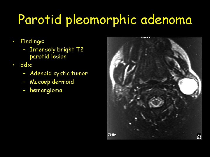Parotid pleomorphic adenoma • Findings: – Intensely bright T 2 parotid lesion • ddx: