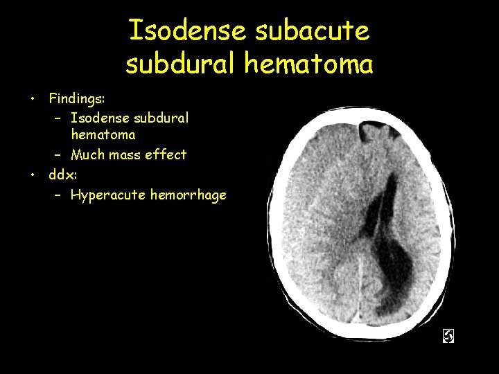Isodense subacute subdural hematoma • Findings: – Isodense subdural hematoma – Much mass effect
