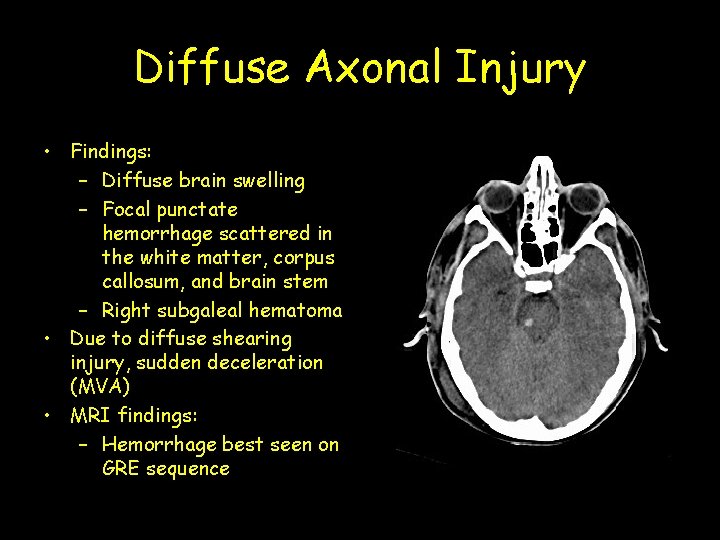 Diffuse Axonal Injury • Findings: – Diffuse brain swelling – Focal punctate hemorrhage scattered