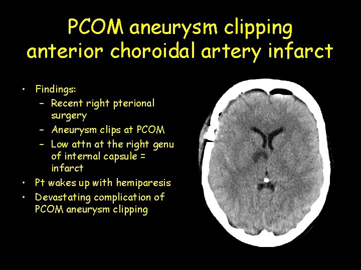 PCOM aneurysm clipping anterior choroidal artery infarct • Findings: – Recent right pterional surgery