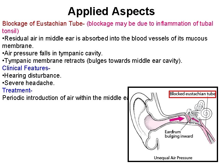 Applied Aspects Blockage of Eustachian Tube- (blockage may be due to inflammation of tubal