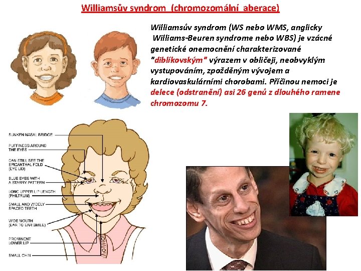 Williamsův syndrom (chromozomální aberace) Williamsův syndrom (WS nebo WMS, anglicky Williams-Beuren syndrome nebo WBS)
