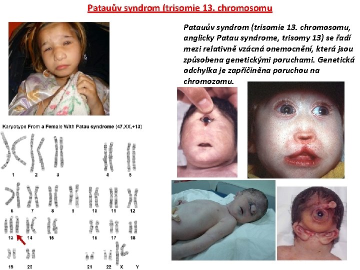 Patauův syndrom (trisomie 13. chromosomu, anglicky Patau syndrome, trisomy 13) se řadí mezi relativně