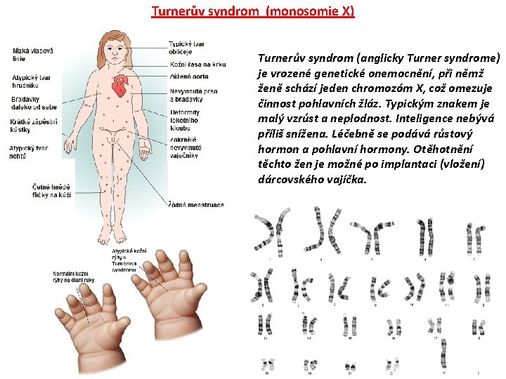 Turnerův syndrom (monosomie X) Turnerův syndrom (anglicky Turner syndrome) je vrozené genetické onemocnění, při