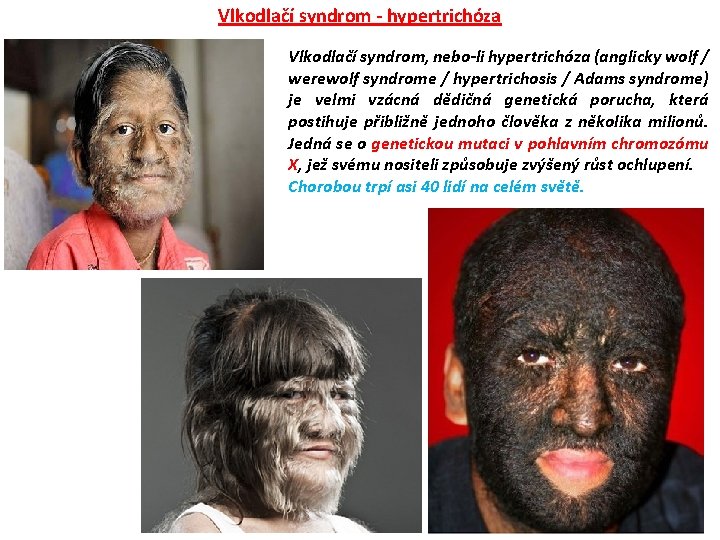 Vlkodlačí syndrom - hypertrichóza Vlkodlačí syndrom, nebo-li hypertrichóza (anglicky wolf / werewolf syndrome /