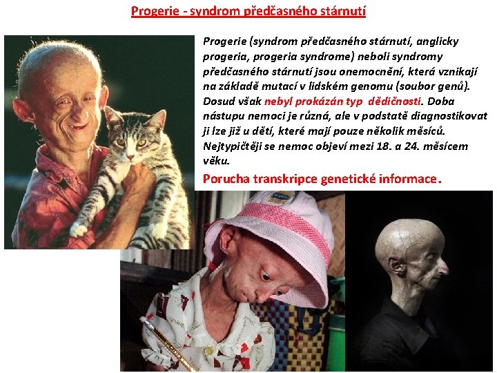 Progerie - syndrom předčasného stárnutí Progerie (syndrom předčasného stárnutí, anglicky progeria, progeria syndrome) neboli