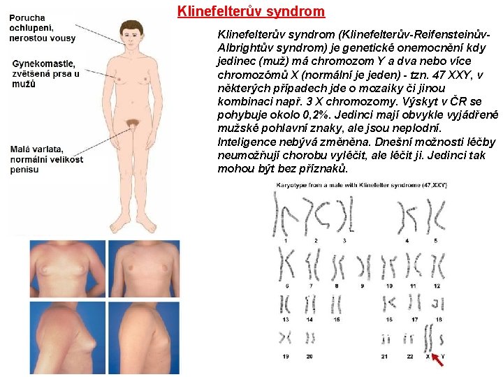 Klinefelterův syndrom (Klinefelterův-Reifensteinův. Albrightův syndrom) je genetické onemocnění kdy jedinec (muž) má chromozom Y