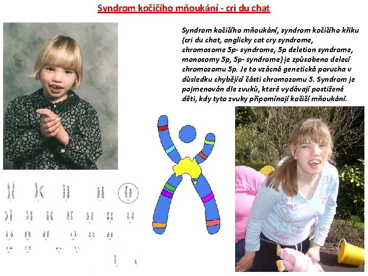 Syndrom kočičího mňoukání - cri du chat Syndrom kočičího mňoukání, syndrom kočičího křiku (cri