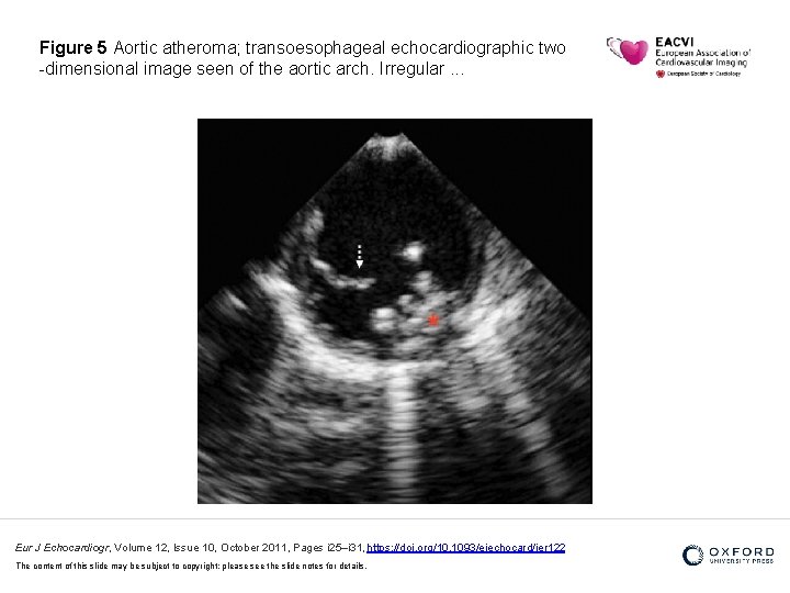 Figure 5 Aortic atheroma; transoesophageal echocardiographic two -dimensional image seen of the aortic arch.