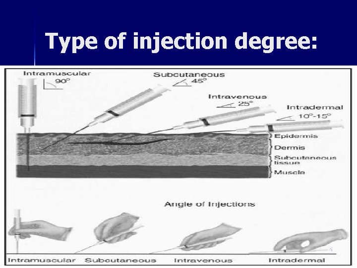 Type of injection degree: 35 