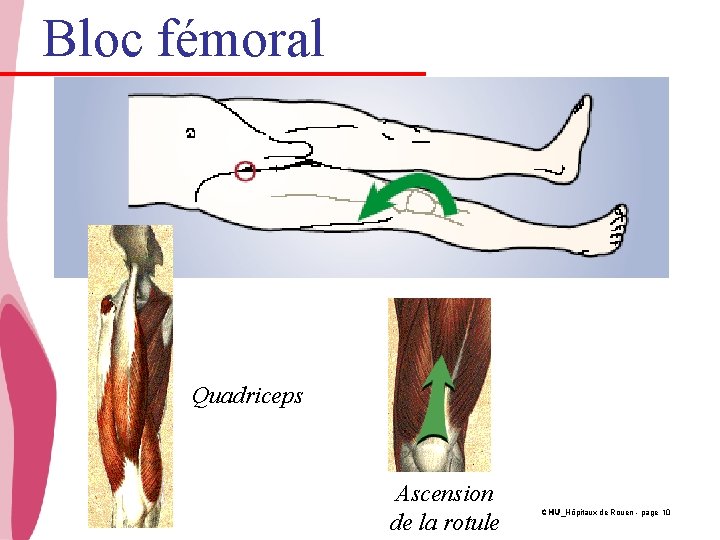 Bloc fémoral Quadriceps Ascension de la rotule CHU_Hôpitaux de Rouen - page 10 