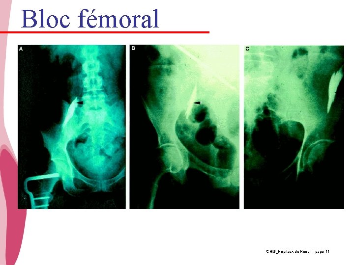 Bloc fémoral CHU_Hôpitaux de Rouen - page 11 