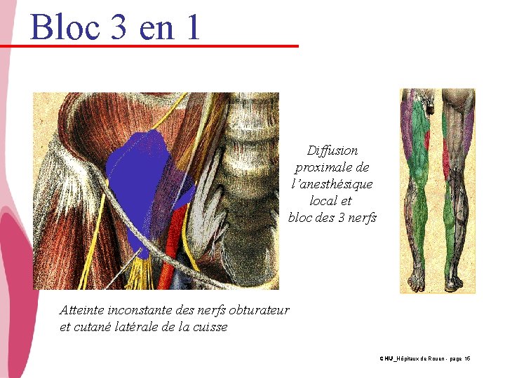 Bloc 3 en 1 Diffusion proximale de l’anesthésique local et bloc des 3 nerfs