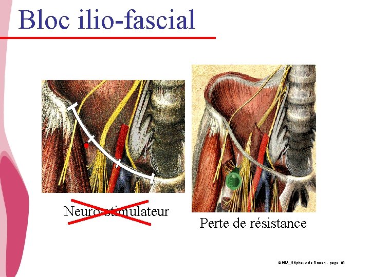 Bloc ilio-fascial Neuro-stimulateur Perte de résistance CHU_Hôpitaux de Rouen - page 18 