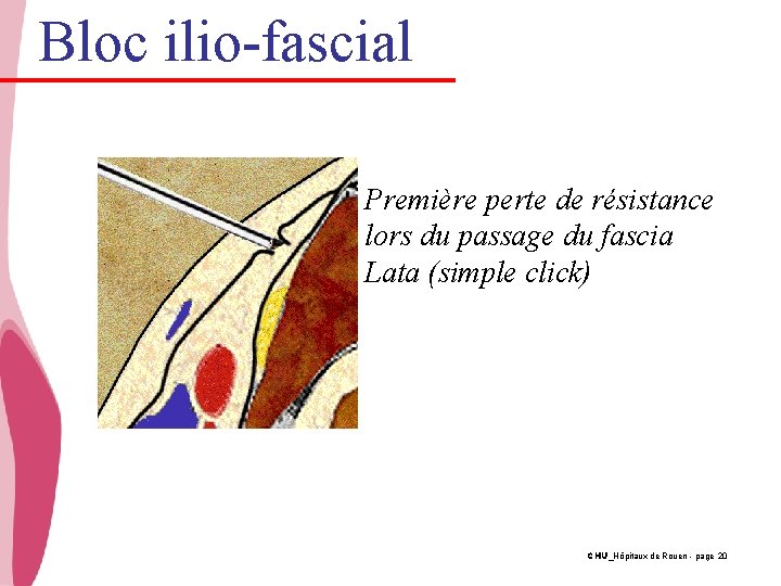 Bloc ilio-fascial Première perte de résistance lors du passage du fascia Lata (simple click)