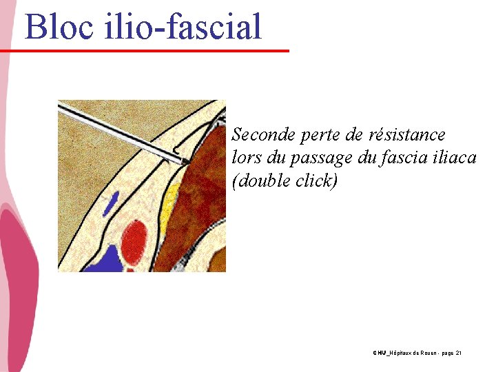 Bloc ilio-fascial Seconde perte de résistance lors du passage du fascia iliaca (double click)