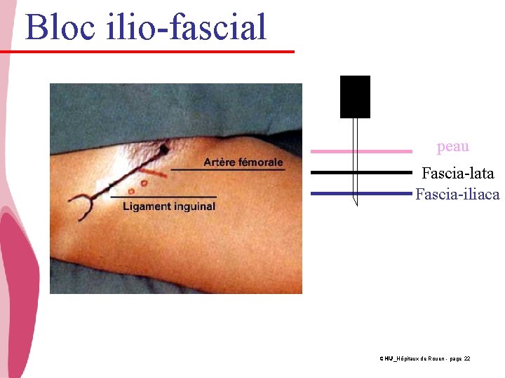 Bloc ilio-fascial peau Fascia-lata Fascia-iliaca CHU_Hôpitaux de Rouen - page 22 