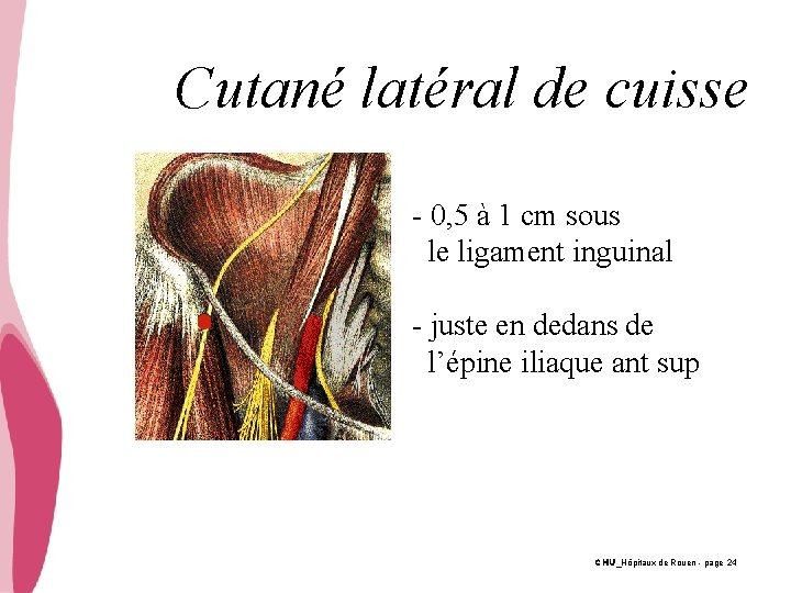 Cutané latéral de cuisse - 0, 5 à 1 cm sous le ligament inguinal