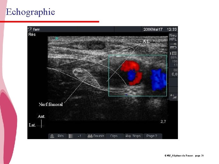 Echographie CHU_Hôpitaux de Rouen - page 31 