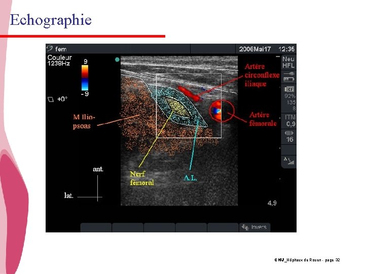 Echographie CHU_Hôpitaux de Rouen - page 32 