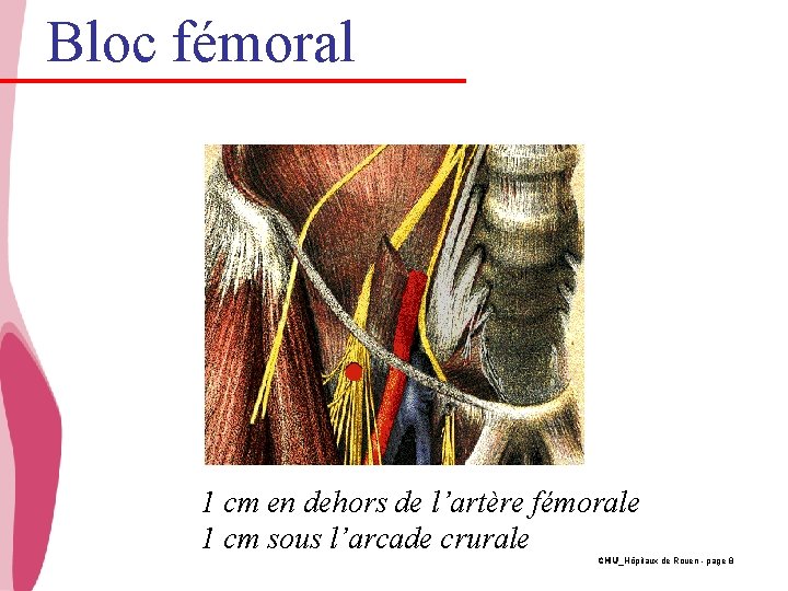 Bloc fémoral 1 cm en dehors de l’artère fémorale 1 cm sous l’arcade crurale