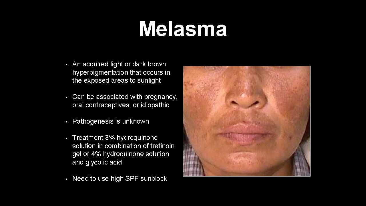 Melasma • An acquired light or dark brown hyperpigmentation that occurs in the exposed