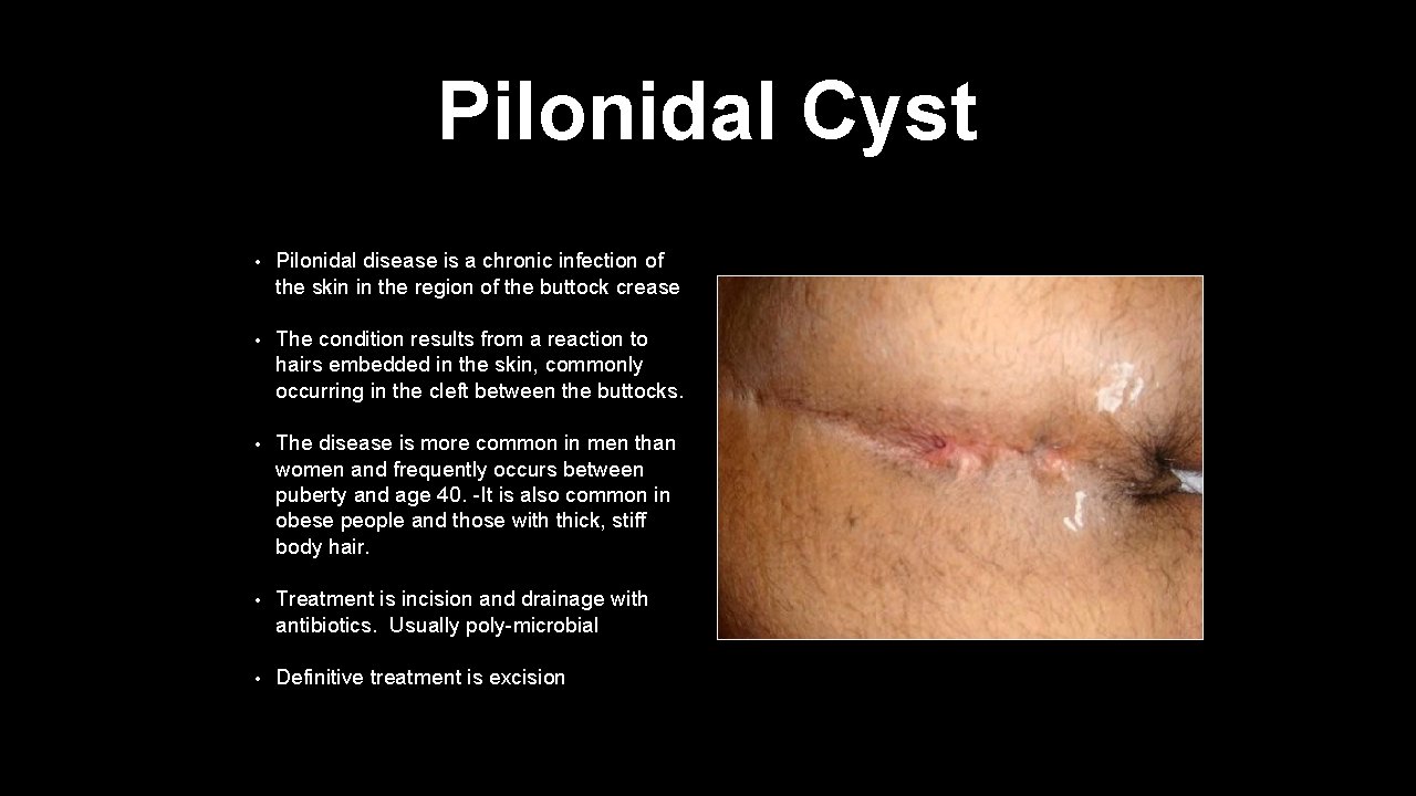 Pilonidal Cyst • Pilonidal disease is a chronic infection of the skin in the