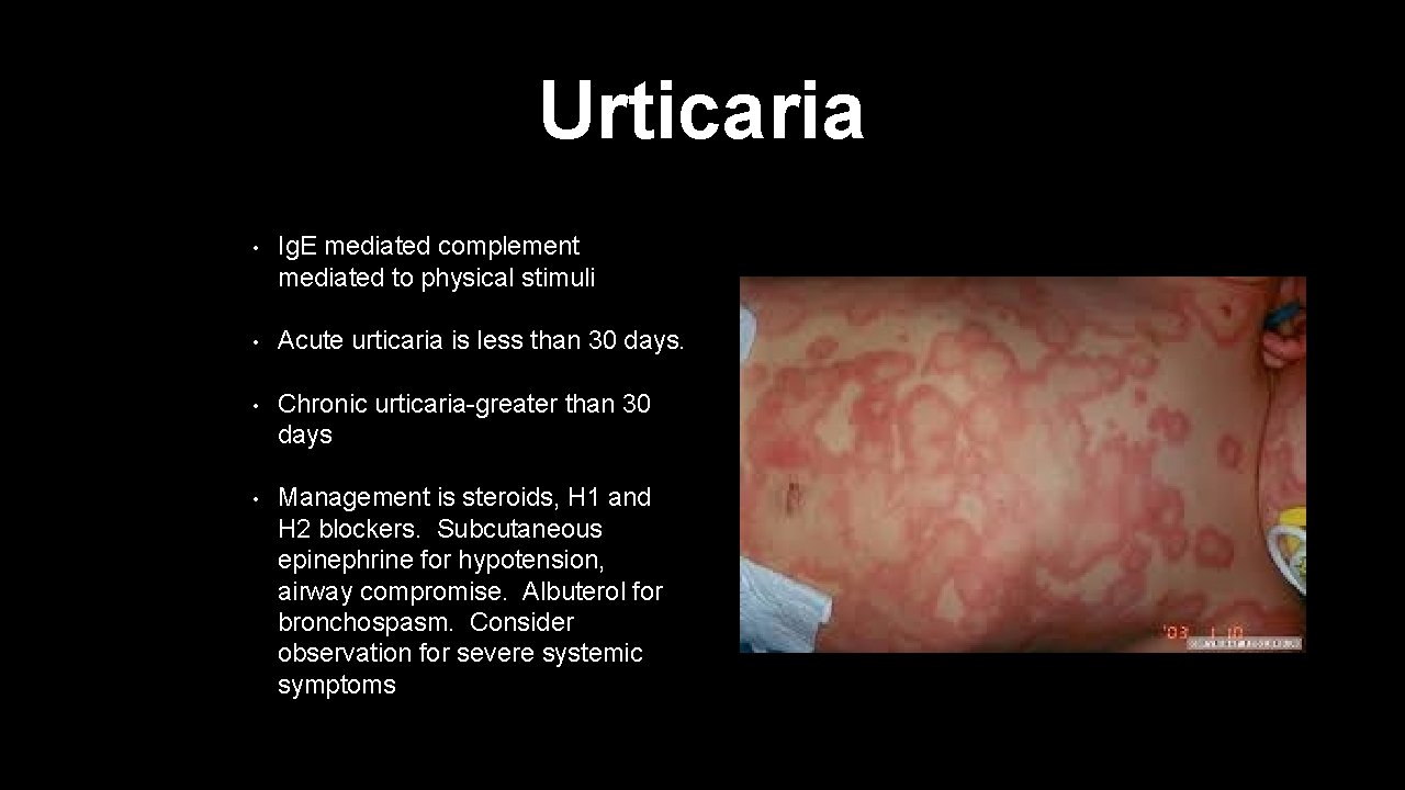 Urticaria • Ig. E mediated complement mediated to physical stimuli • Acute urticaria is