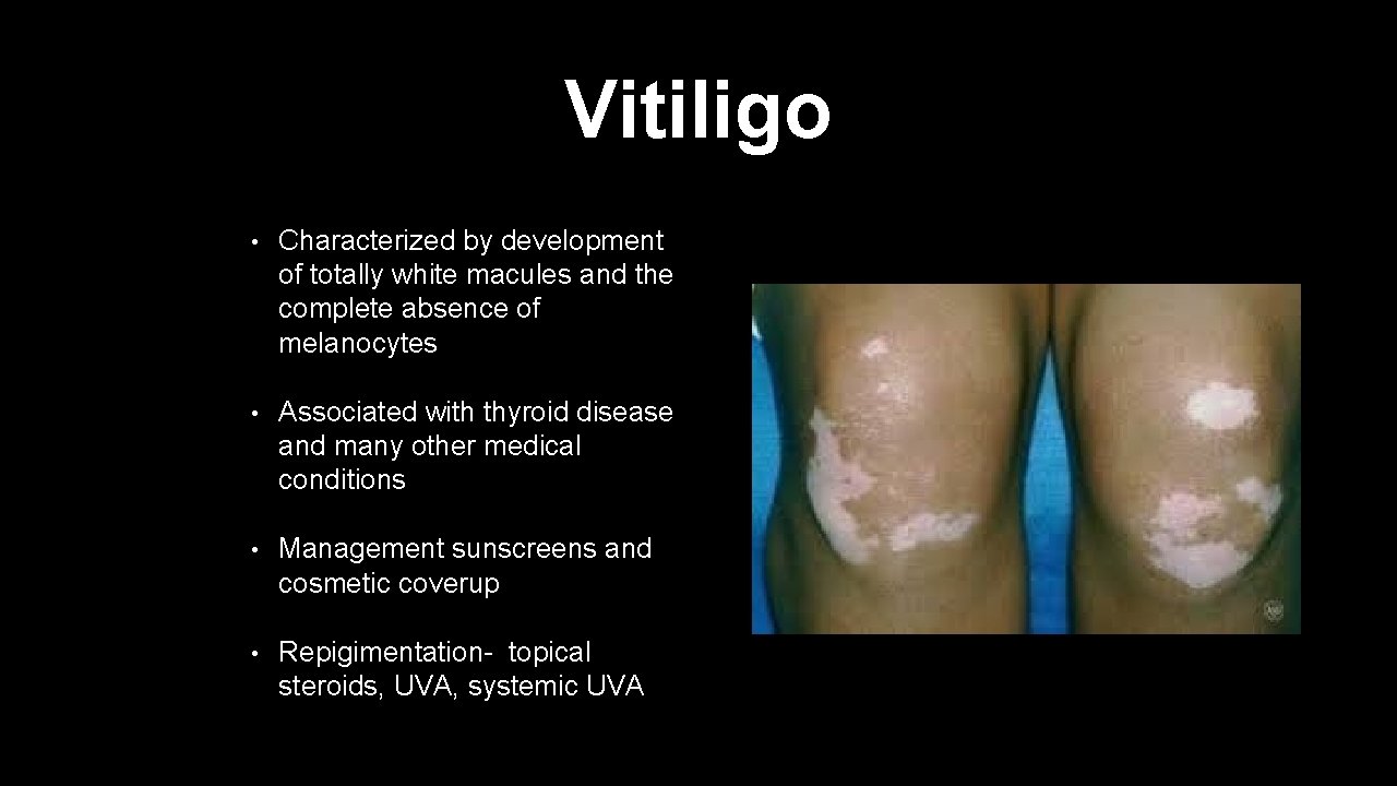 Vitiligo • Characterized by development of totally white macules and the complete absence of