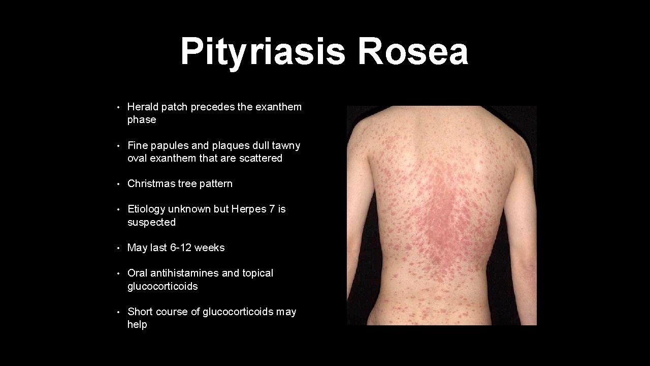 Pityriasis Rosea • Herald patch precedes the exanthem phase • Fine papules and plaques