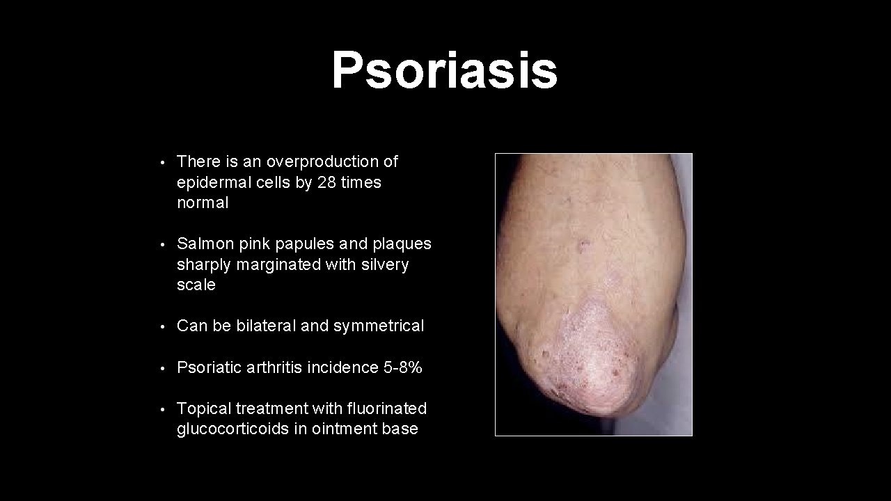 Psoriasis • There is an overproduction of epidermal cells by 28 times normal •